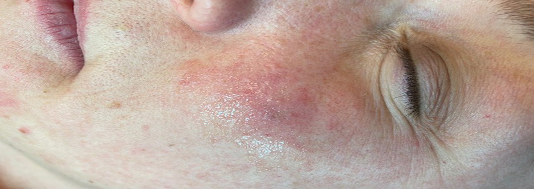 Angioma senilis